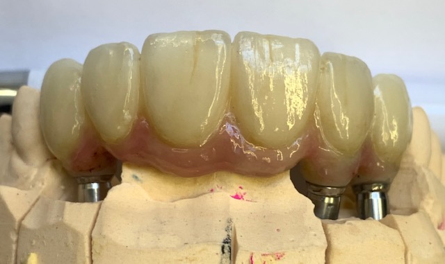 6 unit bridge on 3 implants